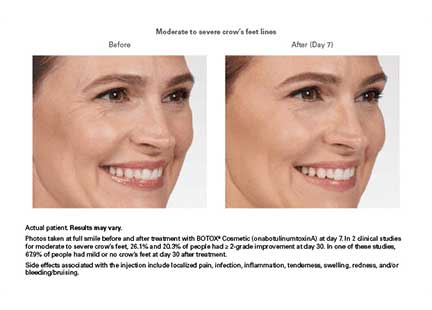 Botox Before & After Image