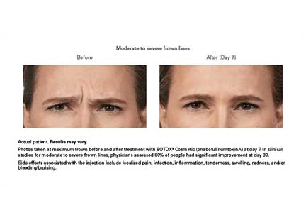 Botox Before & After Image