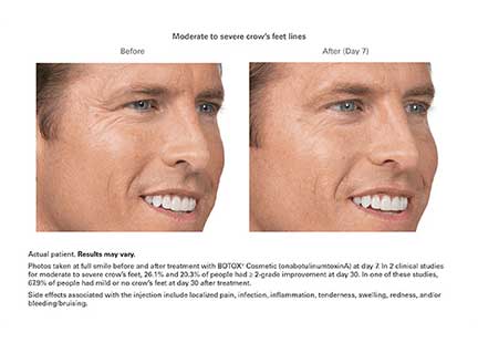 Botox Before & After Image