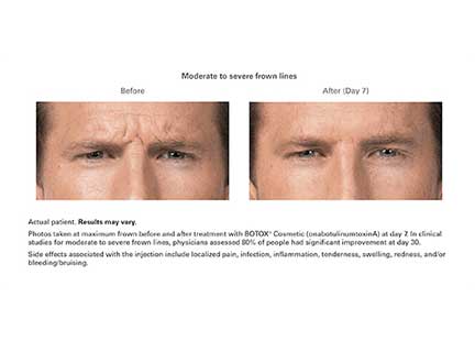 Botox Before & After Image