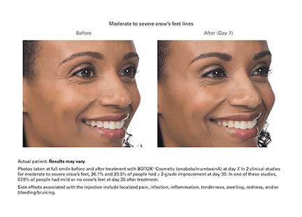 Botox Before & After Image