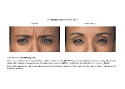 Botox Before & After Image