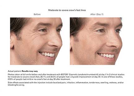 Botox Before & After Image