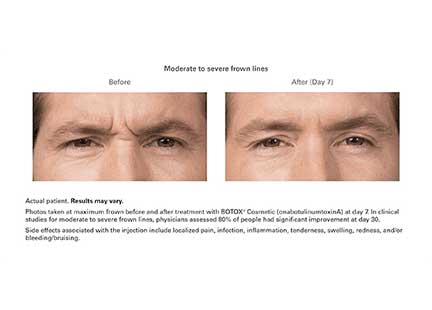 Botox Before & After Image