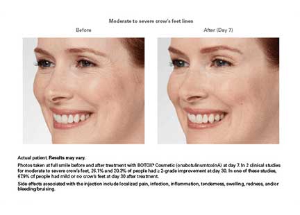 Botox Before & After Image
