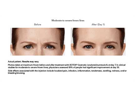 Botox Before & After Image