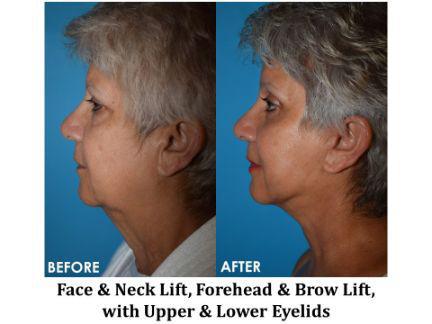 Facial Rejuvenation Before & After Image