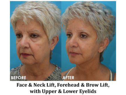 Facial Rejuvenation Before & After Image