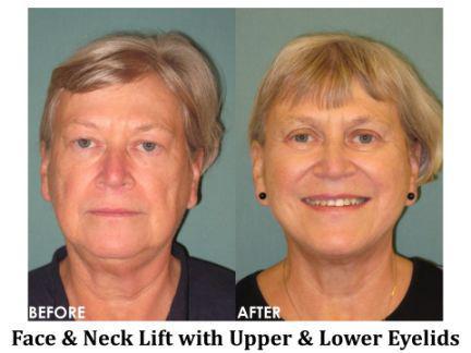 Facial Rejuvenation Before & After Image