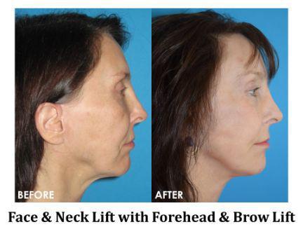 Facial Rejuvenation Before & After Image