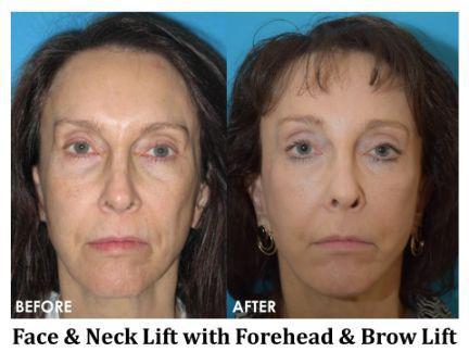 Facial Rejuvenation Before & After Image