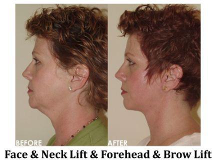 Facial Rejuvenation Before & After Image