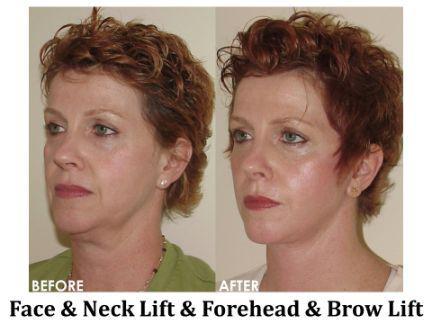 Facial Rejuvenation Before & After Image