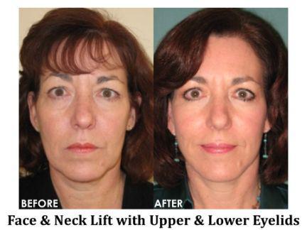 Facial Rejuvenation Before & After Image