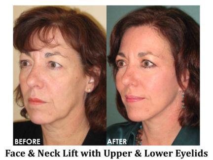 Facial Rejuvenation Before & After Image