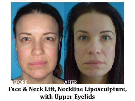 Facial Rejuvenation Before & After Image