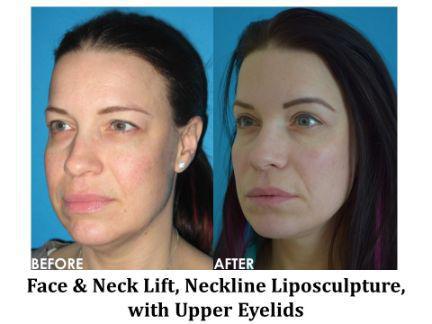 Facial Rejuvenation Before & After Image