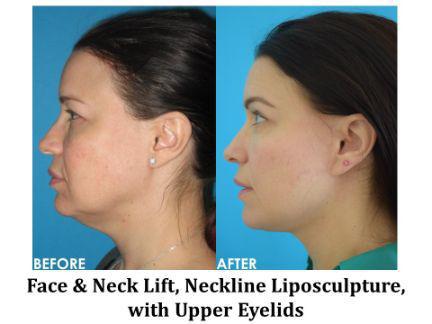 Facial Rejuvenation Before & After Image