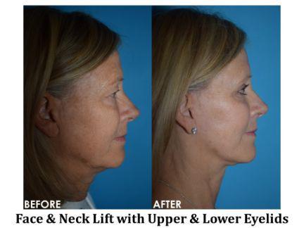 Facial Rejuvenation Before & After Image