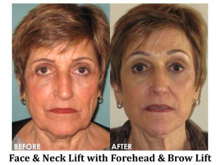 Facial Rejuvenation Before & After Image