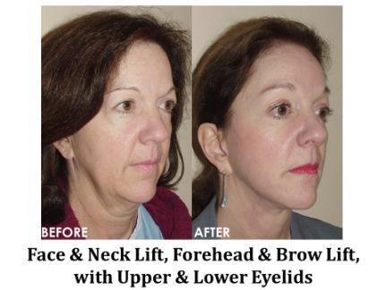 Facial Rejuvenation Before & After Image