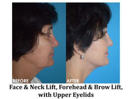 Facial Rejuvenation Before & After Image