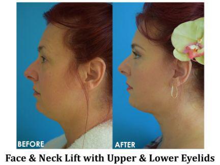 Facial Rejuvenation Before & After Image