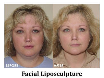 Facial Rejuvenation Before & After Image