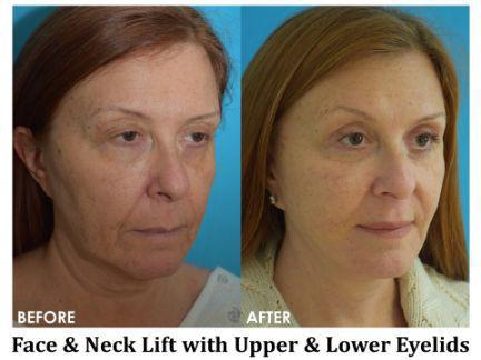 Facial Rejuvenation Before & After Image