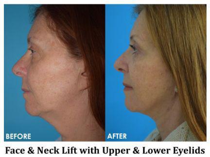 Facial Rejuvenation Before & After Image
