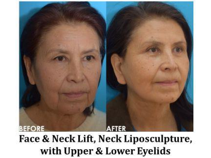 Facial Rejuvenation Before & After Image