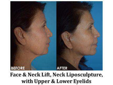 Facial Rejuvenation Before & After Image