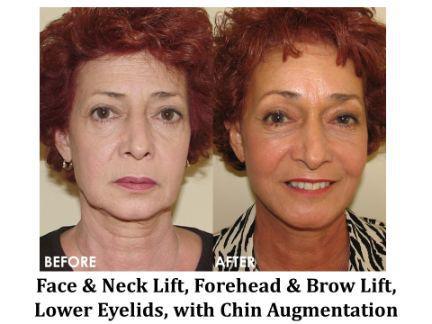 Facial Rejuvenation Before & After Image