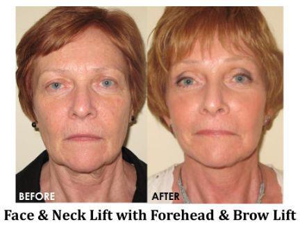 Facial Rejuvenation Before & After Image