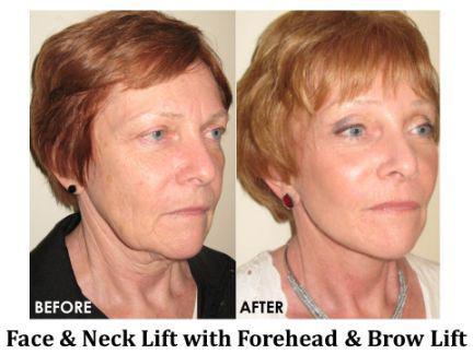 Facial Rejuvenation Before & After Image