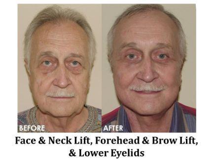 Facial Rejuvenation Before & After Image