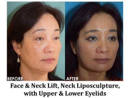 Facial Rejuvenation Before & After Image