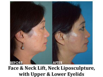 Facial Rejuvenation Before & After Image