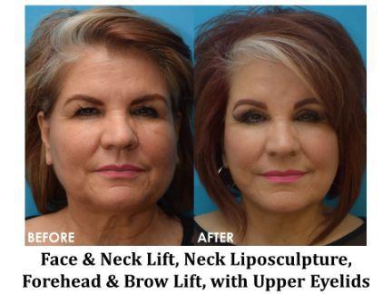 Facial Rejuvenation Before & After Image