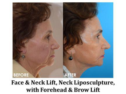 Facial Rejuvenation Before & After Image