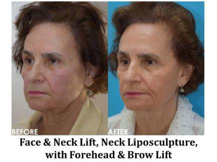 Facial Rejuvenation Before & After Image