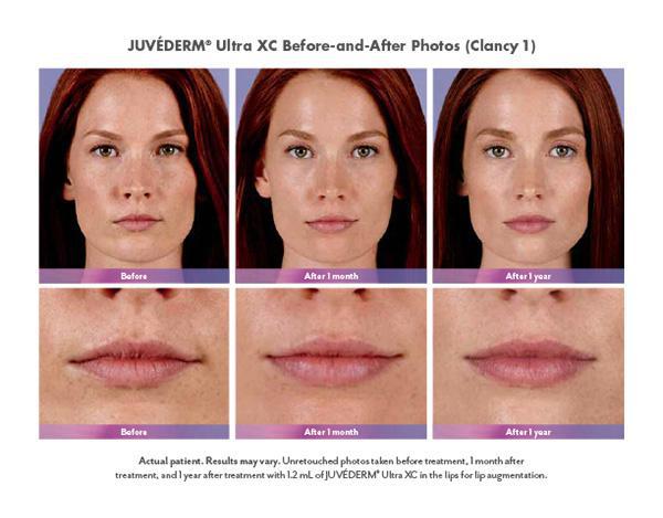 Juvederm Before & After Image