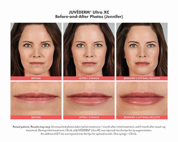 Juvederm Before & After Image