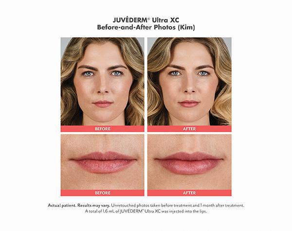 Juvederm Before & After Image