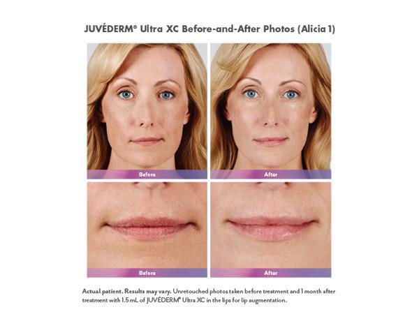 Juvederm Before & After Image