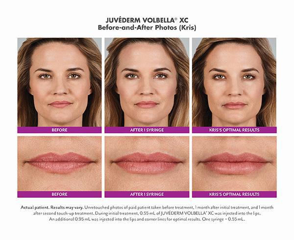 Juvederm Before & After Image