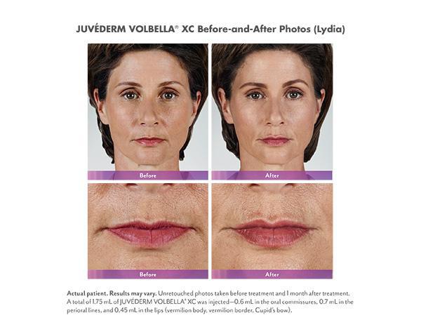 Juvederm Before & After Image