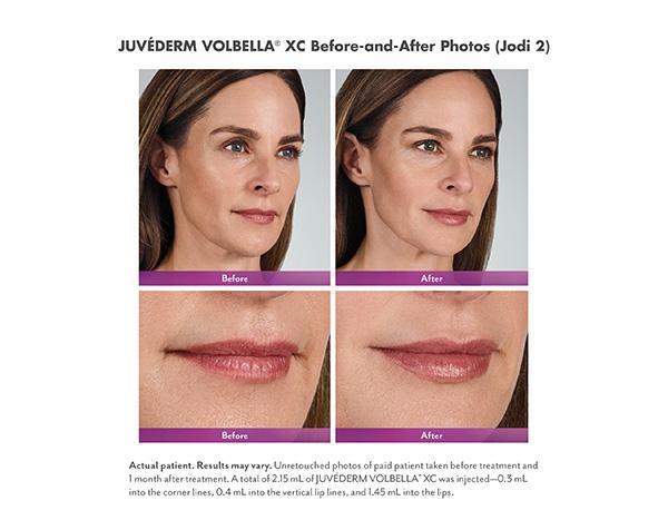 Juvederm Before & After Image