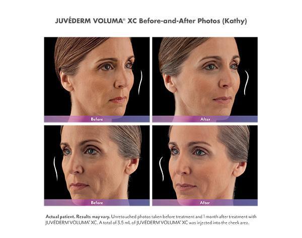 Juvederm Before & After Image