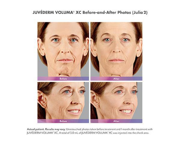 Juvederm Before & After Image